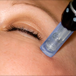 Micro Needling